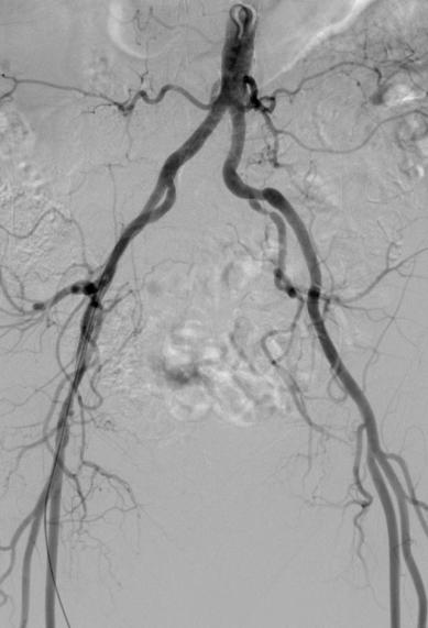 Imaging- Angiogram What are the options for