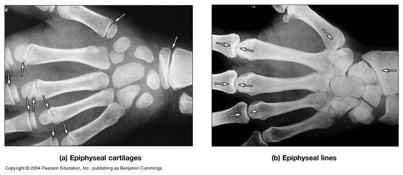Specific Skeletal Changes with Age - 2 Ossification and Closure of Epiphyseal Plates (by 18 in females; 21 in males) due
