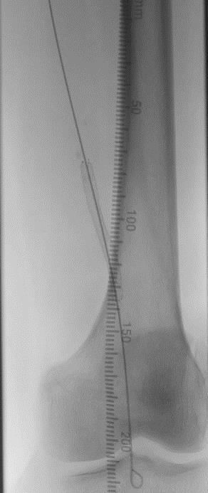 6 x 60 mm stent implanted