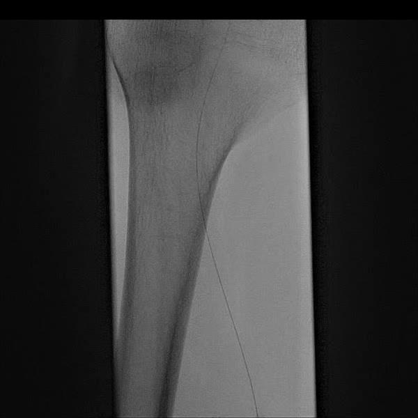 Thrombotic occlusion due to AF 7F 1.