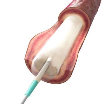 Drug-Coated Balloons offer physicians an attractive value proposition for the treatment of lower limb disease Encouraging results have been seen in de novo, restenotic lesions, in-stent restenosis, &