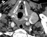Aortic Dissection CTA Takayasu s