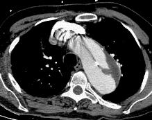 age 15-30 Commonly affects the aorta