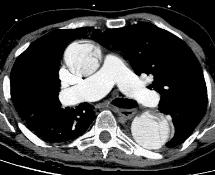 -aortic calcifications in later