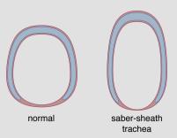 Always look at the trachea size