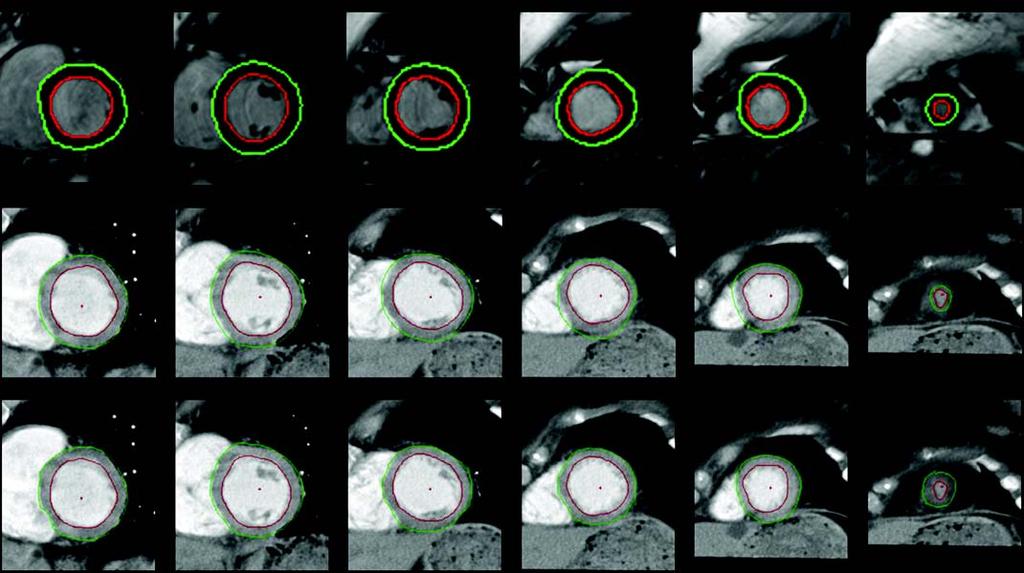 CT of Left Ventricular Parameters Downloaded from www.ajronline.org by 148.251.232.83 on 5/3/18 from IP address 148.251.232.83. Copyright RRS. For personal use only; all rights reserved Fig. 9.