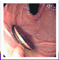 passed into the stomach for removal o Even if asymptomatic: