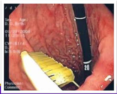 Objects > 6 cm unlikely to pass duodenum o Long (> 45 cm)