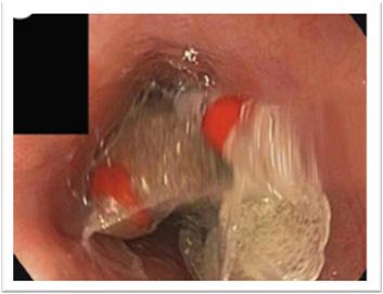 case report of endoscopic removal in esophageal obstruction.