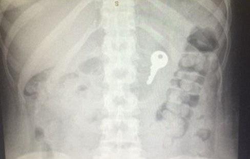 Keys o Emergent endoscopy if: Esophageal obstruction due to food bolus impaction or foreign object