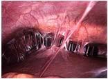 Leiomyomata Pelvic organ prolapse Vulvar vestibulitis Urogenital atrophy