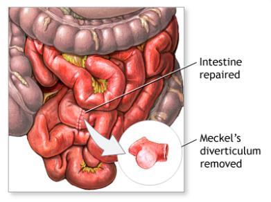 Surgical Findings Final Diagnosis Meckel s diverticulum