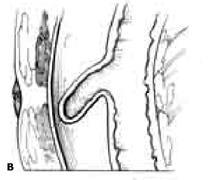 mucosa diverticulitis with a focal perforation of