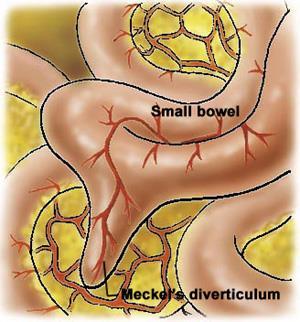 inflammation Meckel s Diverticulum When symptomatic