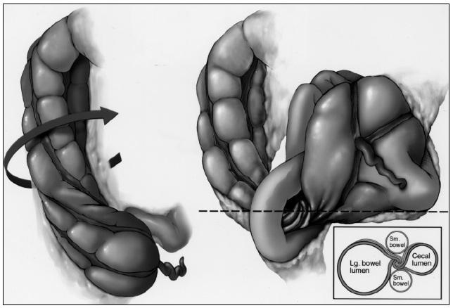 Cecal Volvulus: Definition and Illustration Defined as torsion of the bowel around its own mesentery This image shows cecum