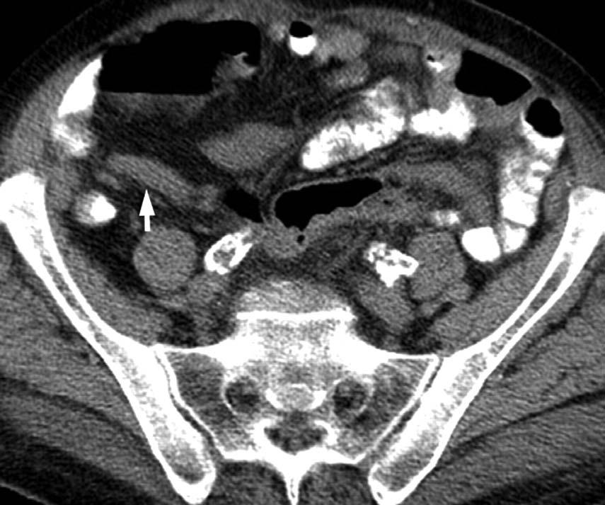 Companion Pt 2: Decompressed Colon Here, we see decompressed right colon distal to the point of volvulus.