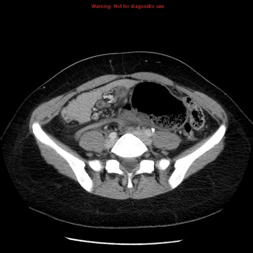 Patient LD: Abdominal CT Scan 1 Dilated cecum, located in LUQ