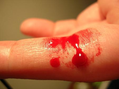 (HEMOSTASIS) The process of stopping bleeding Involves the