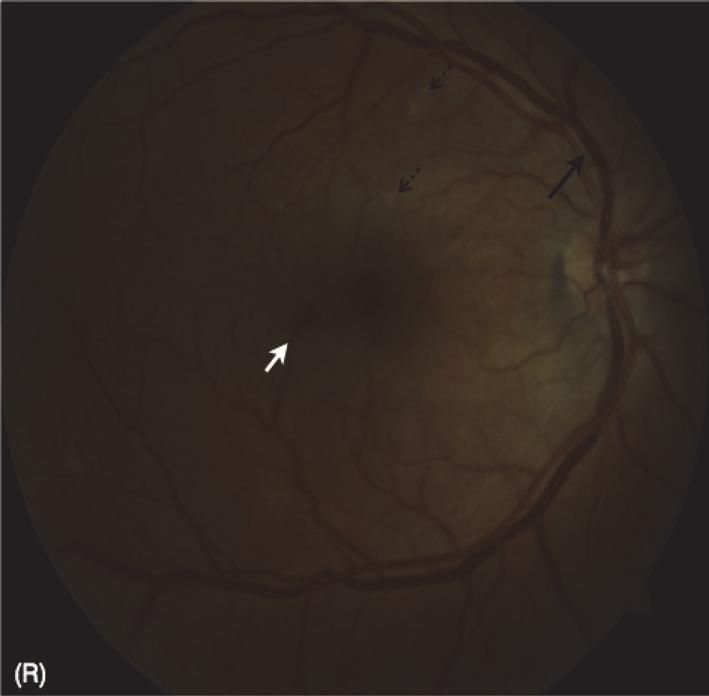 Figure 2: Fundus photographs from the right (R) and