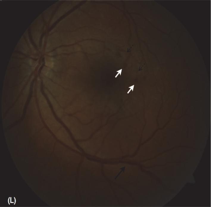 retinal veins (heavy black arrows), intraretinal