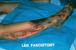 Compartment syndrome Muscle swelling in extremity secondary to trauma Swelling limited by tight muscle fascia Limited space and increased swelling leads to increased pressure Increased pressure