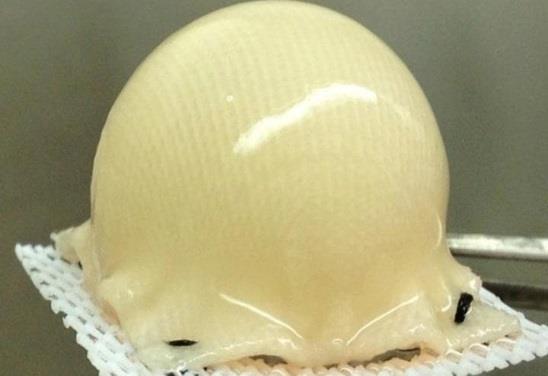 Scaffold Molded to shape of joint, seeded with stem cells taken from fat