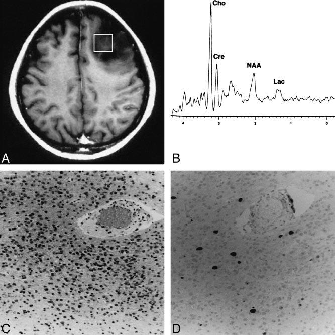 AJNR: 1, April 000 GLIOMAS 66 FIG. Case 11: A typical case in which the spectroscopic voxel is homogeneous without contrast enhancement.