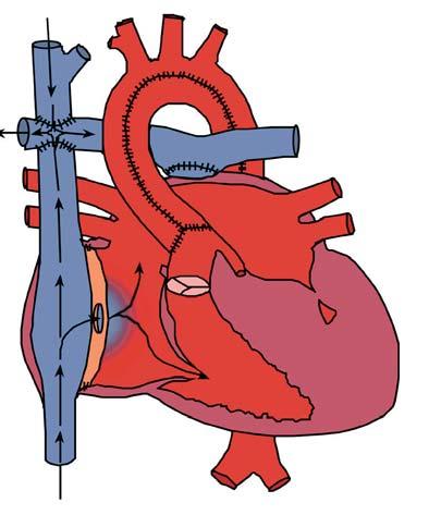 Left Atrium Baffle Fenestration Right Atrium Figure 3 Fenestrated Fontan Purpose of the Device (Indications for Use) The AMPLATZER Septal Occluder is a percutaneous, transcatheter, Atrial Septal