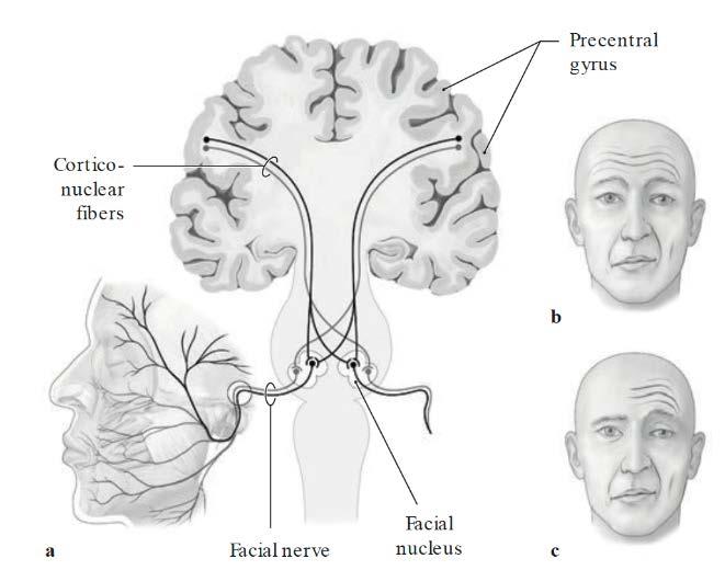 However, irritative lesions of, the facial nerve may lead to pain in the external auditory meatus.