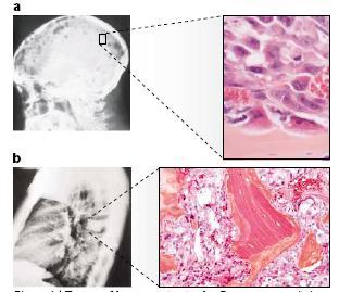 A Success Story: Denosumab Osteoblastic metastases: Osteoblasts build bone Here they build weak, unorganized bone
