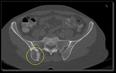 Pain Palliation of Bone Metastases Patient with osteolytic breast cancer metastasis at right iliac bone Pain score of 5.
