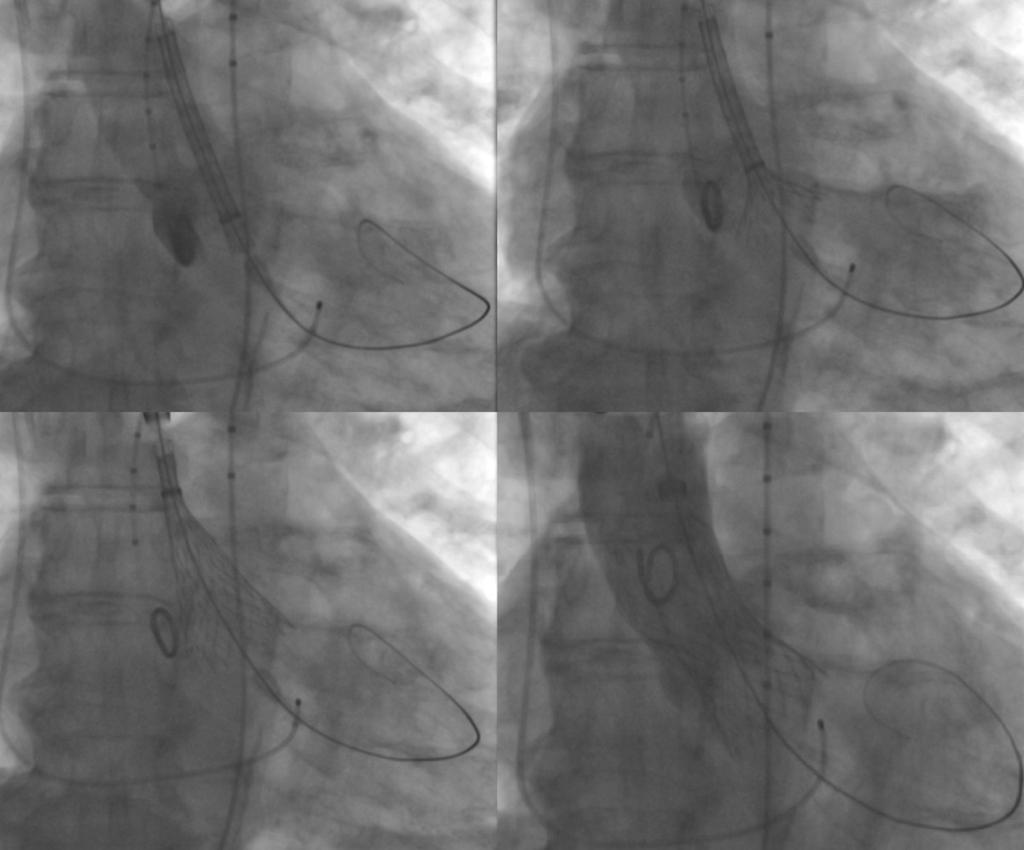 Conclusion Variable helical pitch with ECG gating on a 320 row scanner facilitates the acquisition of motion free images of the aortic root and visualization of the aorta and iliofemoral vessels