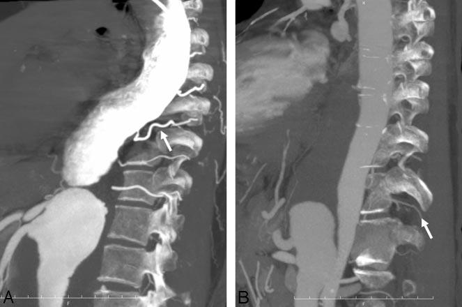 Laterality and levels of the AKA in all of the patients. Fig 4. A, Oblique sagittal partial MIP image of IACTA obtained from a 73-year-old man with TAAA.