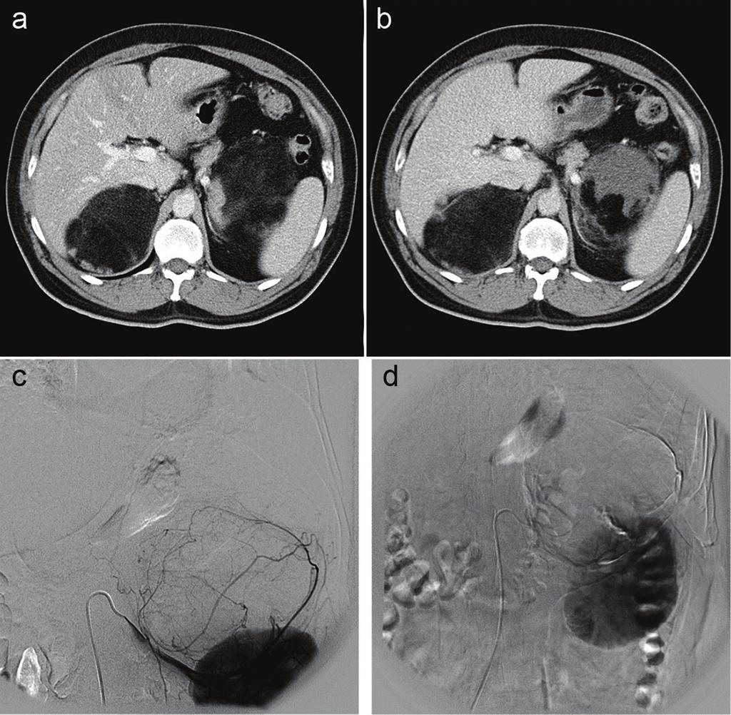 Angioembolization of right middle adrenal artery was conducted using 150 to 250 micron-ivalon. Postembolization showed nearly obliteration of arterial feeders to this mass.