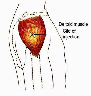 Vastus lateralis muscle (anterolateral thigh) may be used.