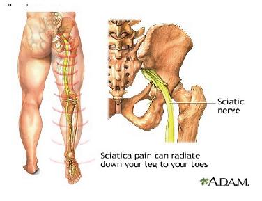 .."[sciatica] is caused by injury to or pressure