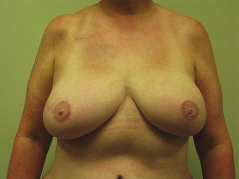 (B, D, F) Postoperative appearance at 33 months following bilateral skin-sparing mastectomies and immediate