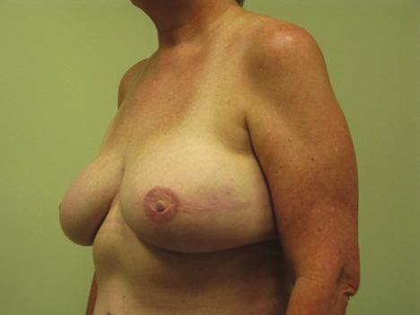 When comparing lesions found on re-excision with those of the original mastectomy report (Table 9), 3 patients