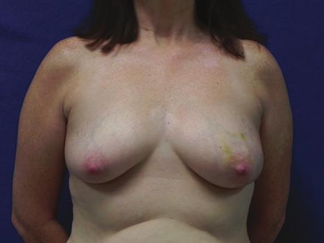 Ochoa et al 9 A B C D E F Figure 2. (A, C, E) Preoperative appearance of a 48-year-old woman with left breast cancer.