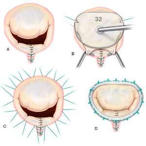 Remodeling the Mitral Valve Annulus Annular remodeling.