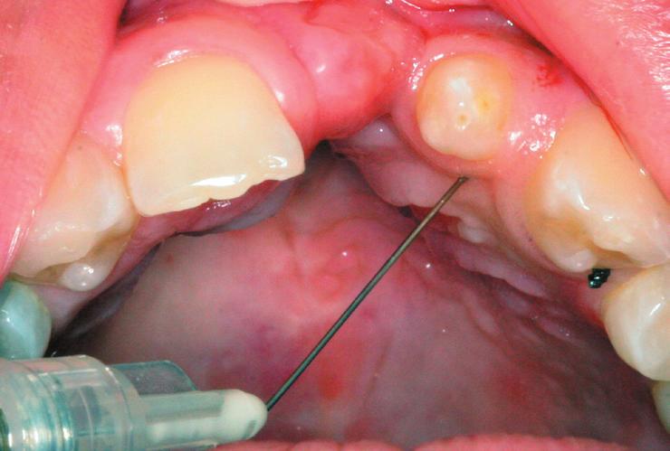 support; B: Intraoral view; C: