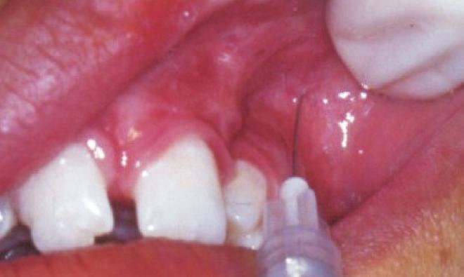 segment - right side); F: Infiltration in the buccal aspect of