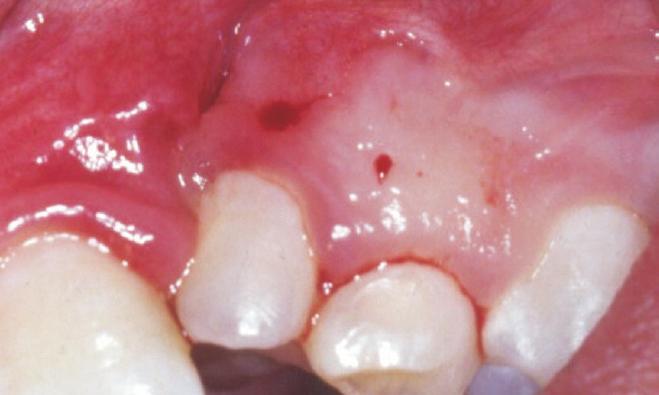 region); G: Infiltration in the palatal aspect of  region); H: