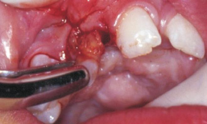 Second infiltration in the cleft area; J: Infiltration in the