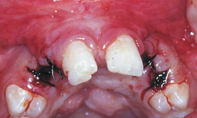 palatal aspect of the  segment - left side); L:extraction