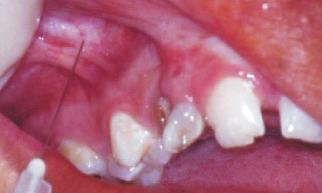 vascular supply in the cleft maxillary complex, based on an in