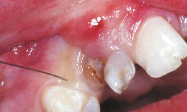 the cleft area; D: Infiltration in the buccal aspect of the