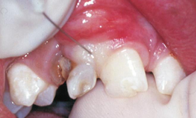 segment - right side); E: Infiltration in palatal aspect of the