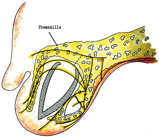 A major nerve branch stems from the nasopalatine nerve located on the cleft side and is responsible for innervating the palatal mucosa.