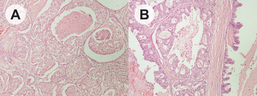 1.7.3 Karcinom pljuvačnih kanala ( Salivary duct carcinoma ) DOKTORSKA DISERTACIJA Karcinom pljuvačnih kanala je visoko maligni epitelni tumor pljuvačnih žlezda sa slikom, gotovo identičnom,